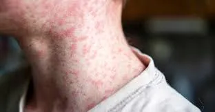 Measles in Australia: What is Measles?