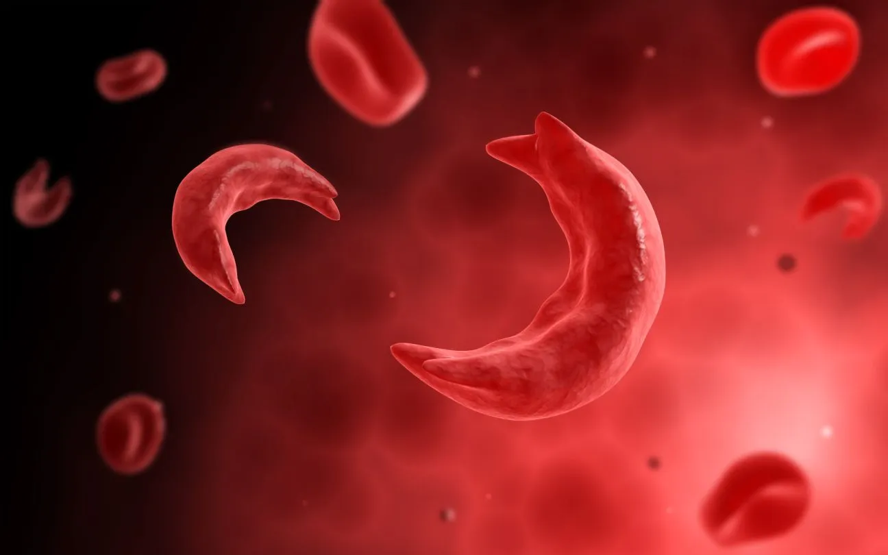 Sickle Cell Disease: About the Study