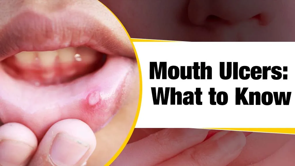 Mouth Ulcers Causes: Know symptoms and 5 home remedies