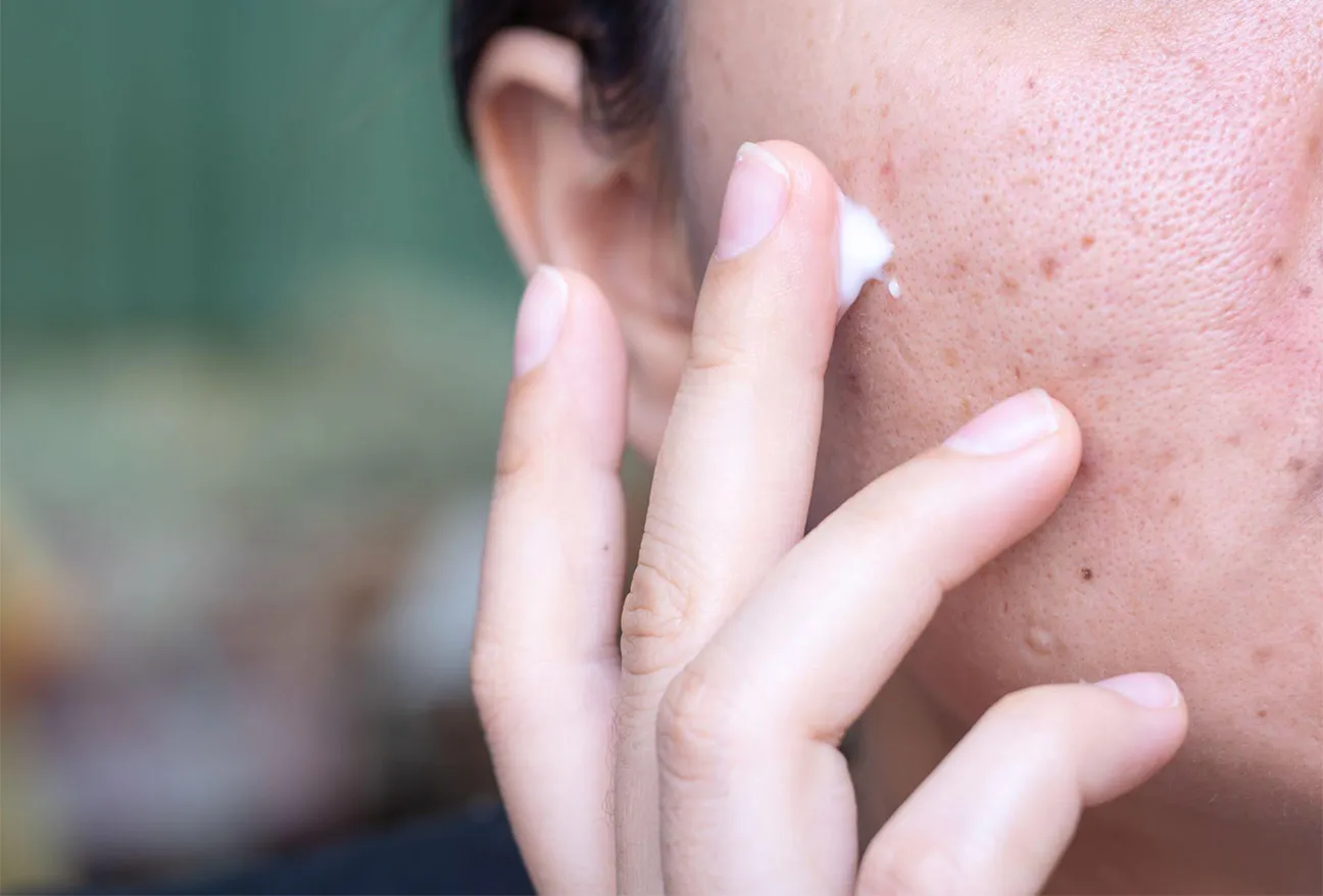 1. Reduces Hyperpigmentation