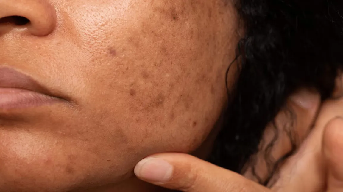 Raw Milk Benefits for Skin