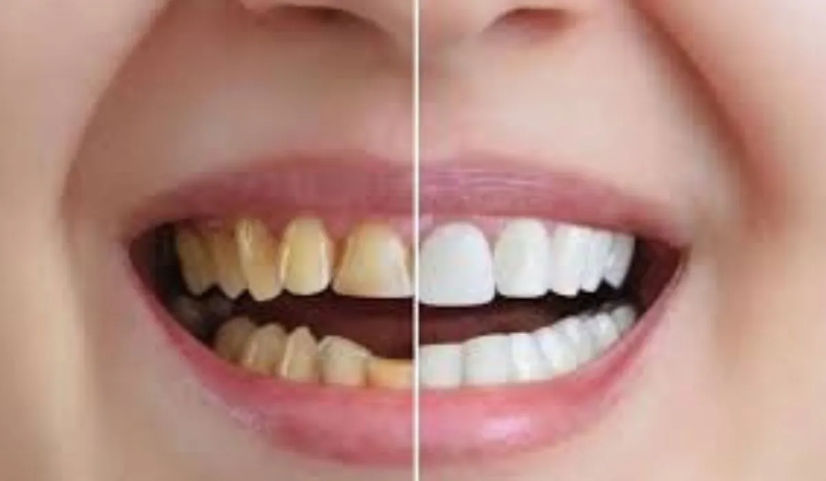 Teeth Whitening Home Remedies
