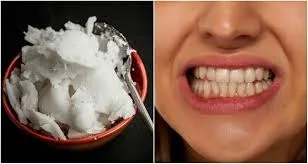 Teeth Whitening Home Remedies
