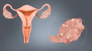 PCOS TO PMOS